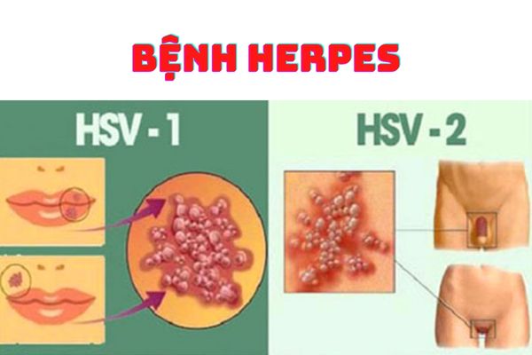 Bệnh Herpes phổ biến ở cả nam và nữ