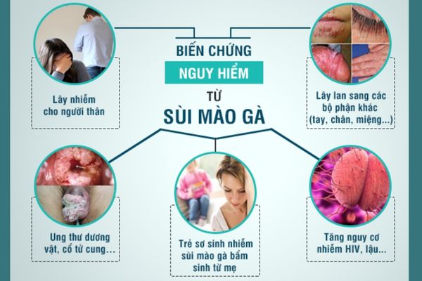 Sùi mào gà gây ra nhiều ảnh hưởng nghiêm trọng