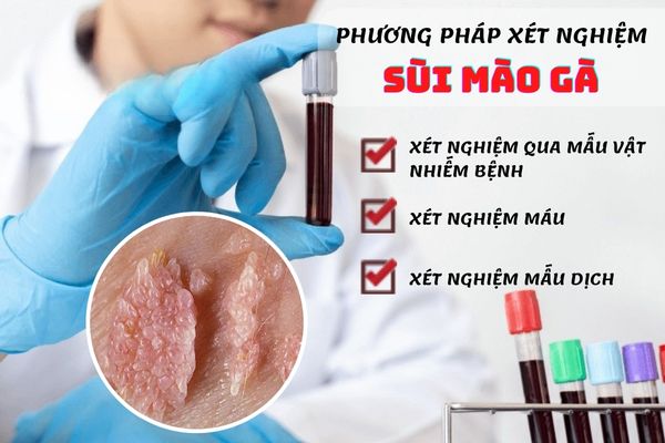 Các phương pháp xét nghiệm sùi mào gà hiệu quả