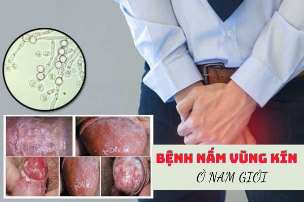 Triệu chứng bệnh giang mai như thế nào? Có nguy hiểm không?