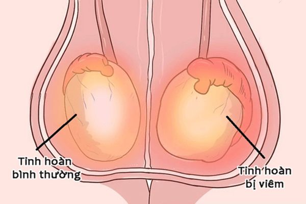 Sùi mào gà giai đoạn đầu – Phát hiện sớm, điều trị hiệu quả