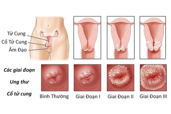 Nguyên nhân tiểu buốt do đâu – Cách điều trị hiệu quả