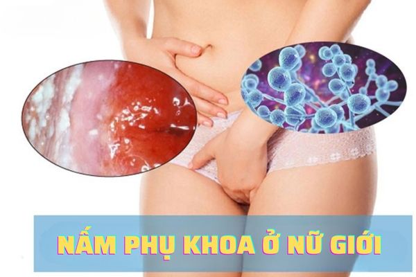 Tìm hiểu nấm phụ khoa là gì? Có nguy hiểm hay không?