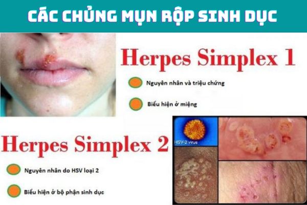 Virus HSV là tác nhân chính gây ra bệnh mụn rộp sinh dục