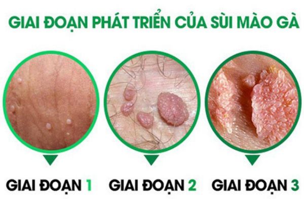 Biểu hiện của bệnh sùi mào gà qua từng giai đoạn