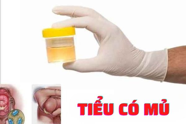 Tiểu có mủ ở nam giới có nguy hiểm không? Cách điều trị hiệu quả