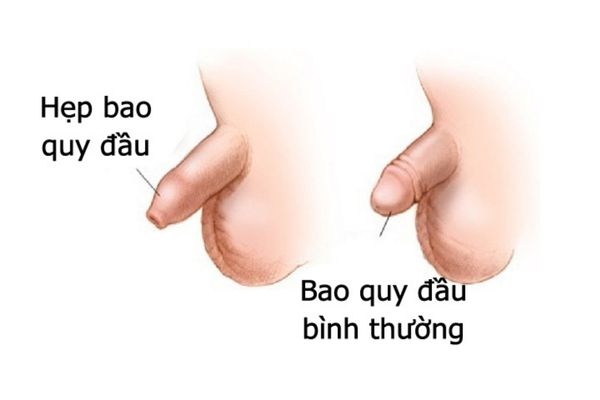 Hẹp bao quy đầu là tình trạng thường xuyên gặp phải ở nam giới