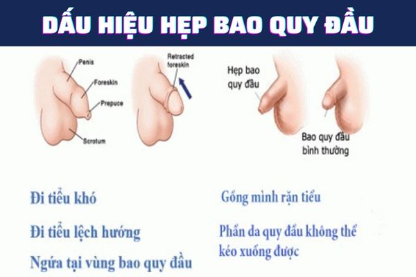 Triệu chứng nhận biết tình trạng hẹp bao quy đầu