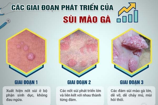 Các giai đoạn phát triển của bệnh sùi mào gà