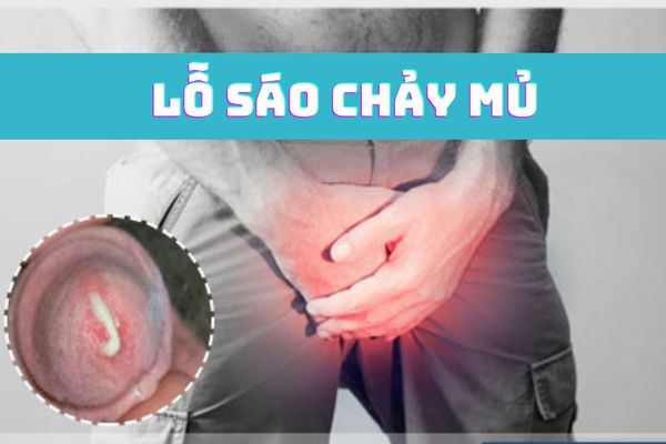 Lỗ sáo chảy mủ – Dấu hiệu bệnh lý không nên xem thường