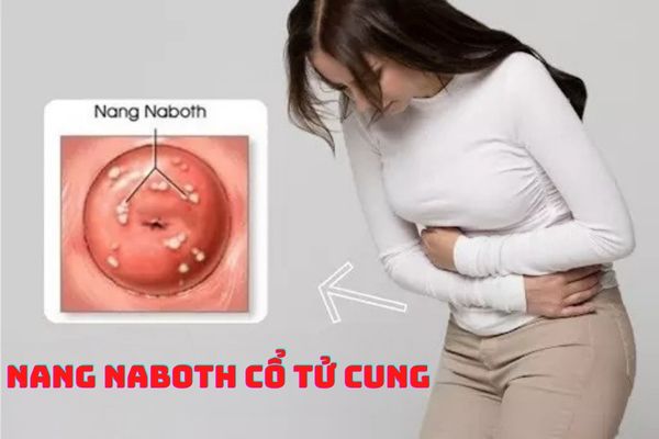 Nang naboth cổ tử cung: Nguyên nhân, triệu chứng và cách điều trị