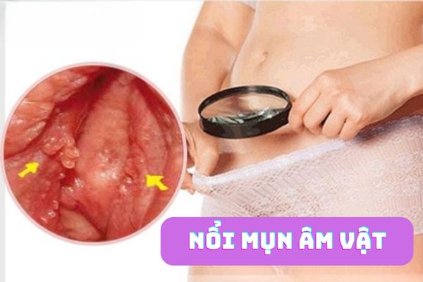 Nguyên nhân nổi mụn âm vật – Cách điều trị hiệu quả