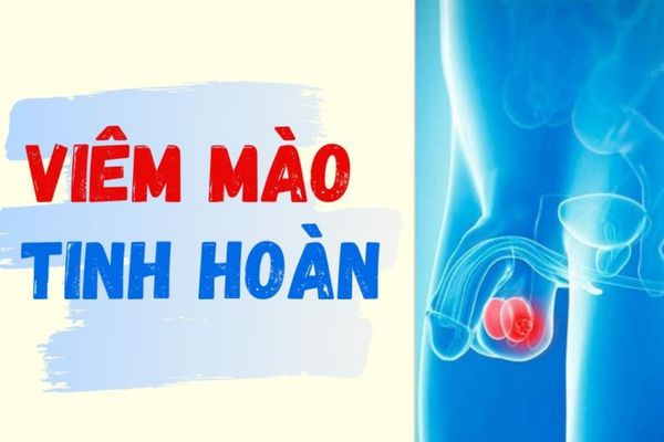 Những dấu hiệu nhận biết viêm mào tinh hoàn ở nam giới