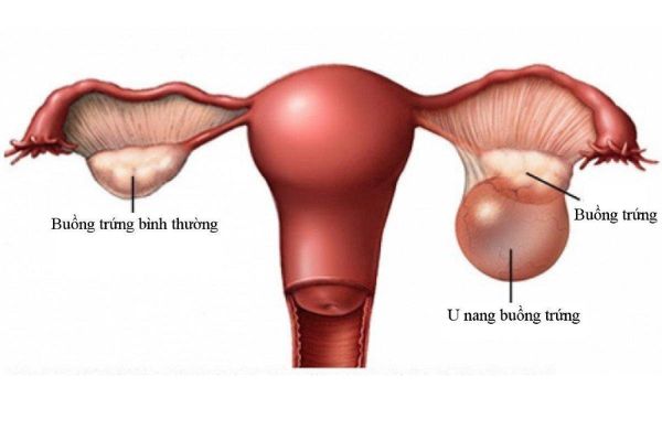 Het-suc-can-trong-voi-tinh-trang-dau-bung-duoi-2