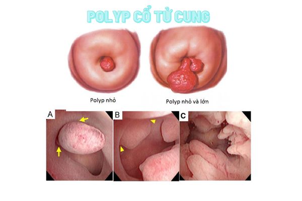 Tong-hop-thong-tin-huu-ich-ve-polyp-co-tu-cung-1